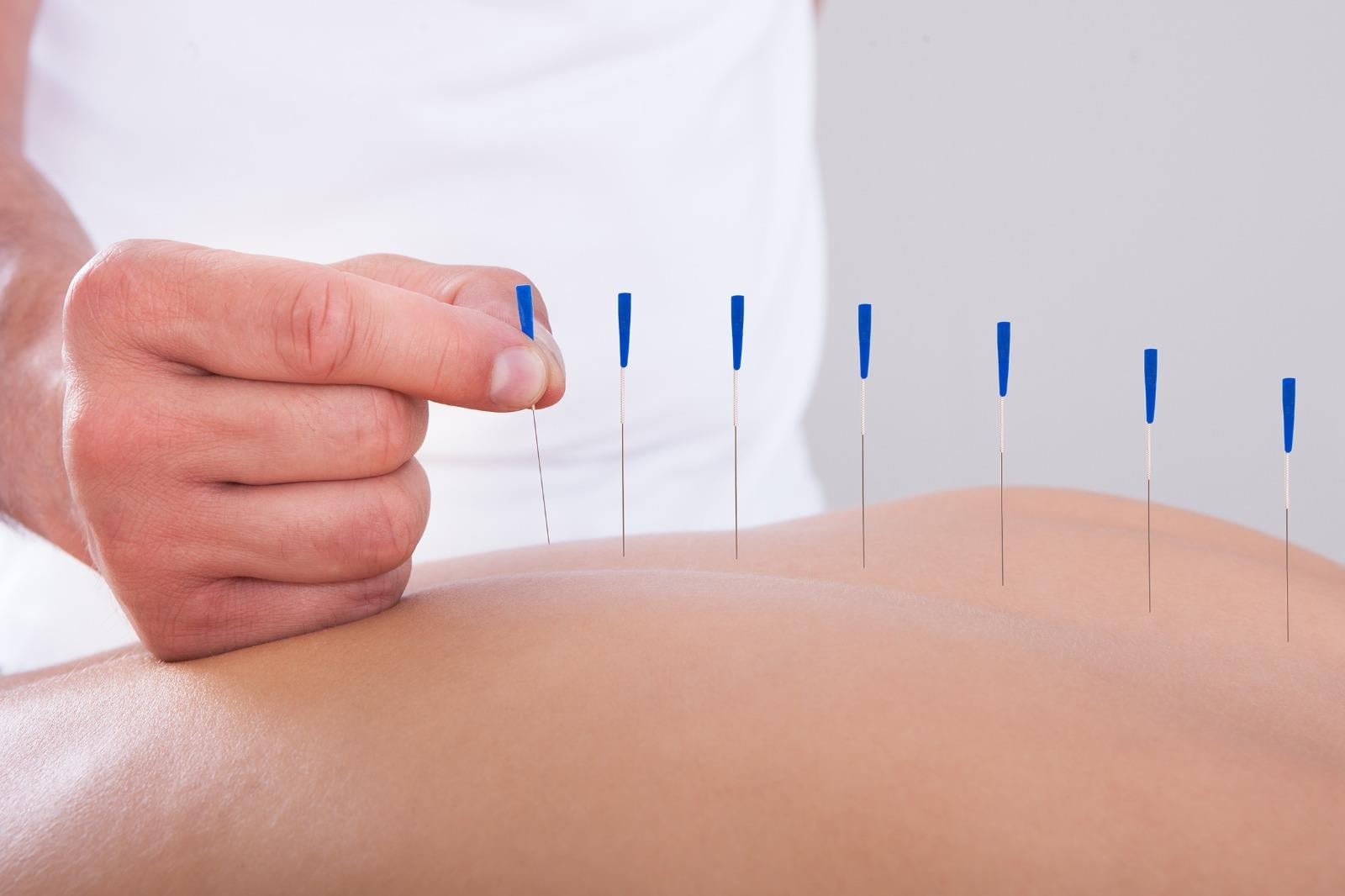 Akupunktur iğnesi kuru iğne, Acupuncture needle 0.25*40mm