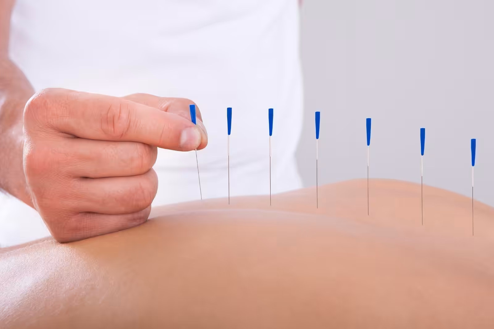 Akupunktur iğnesi kuru iğne, Acupuncture needle 0,30*40mm